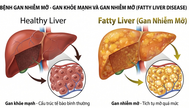 Gan nhiễm mỡ hay m&aacute;u nhiễm mỡ nguy hiểm hơn? - Ảnh 1.
