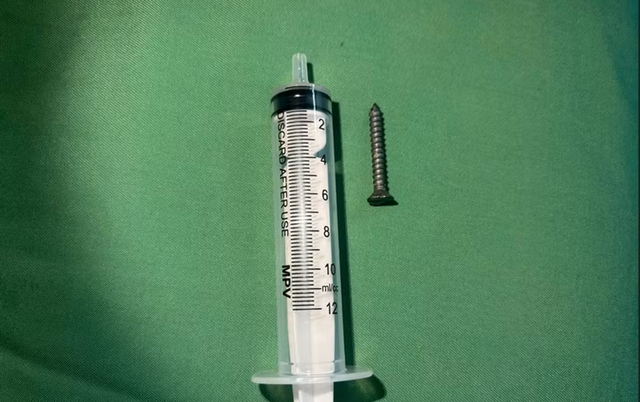 Nuốt đinh, h&oacute;c xương, rơi răng giả: Những ca cấp cứu khiến b&aacute;c sĩ to&aacute;t mồ h&ocirc;i - Ảnh 1.