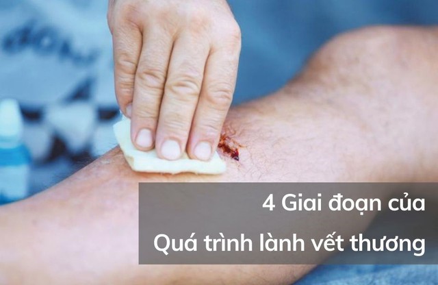 Chuy&ecirc;n gia giải đ&aacute;p: Vết thương hở n&ecirc;n b&ocirc;i g&igrave; để tr&aacute;nh sẹo xấu? - Ảnh 2.