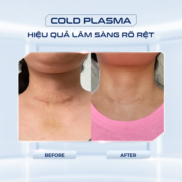 Cold Plasma: C&ocirc;ng nghệ gi&uacute;p kiểm so&aacute;t nhiễm khuẩn trong thẩm mỹ - Ảnh 2.