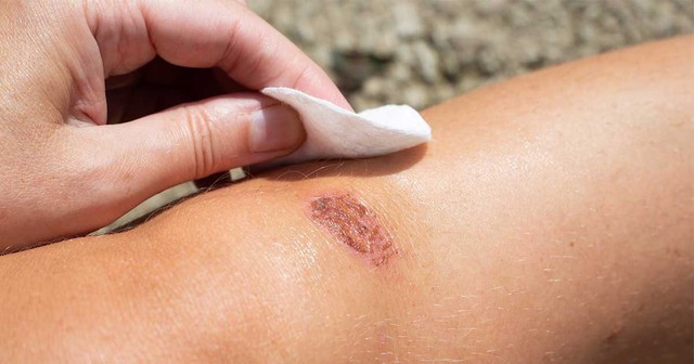 Chuy&ecirc;n gia giải đ&aacute;p: Vết thương hở n&ecirc;n b&ocirc;i g&igrave; để tr&aacute;nh sẹo xấu? - Ảnh 4.