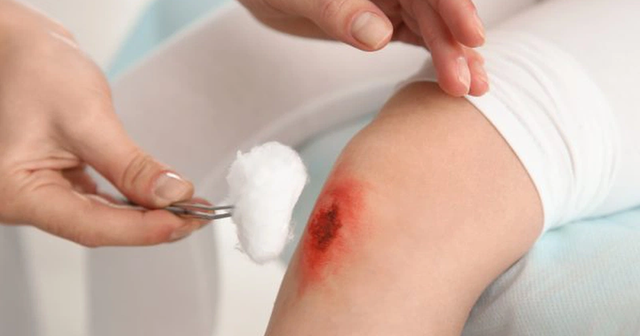 Chuy&ecirc;n gia giải đ&aacute;p: Vết thương hở n&ecirc;n b&ocirc;i g&igrave; để tr&aacute;nh sẹo xấu? - Ảnh 6.