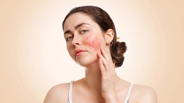 Kỷ nguy&ecirc;n mới điều trị lupus ban đỏ hệ thống: Nhắm tr&uacute;ng đ&iacute;ch, hướng tới lui bệnh - Ảnh 3.
