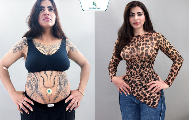 JK Nhật H&agrave;n đầu tư Microaire PAL thứ hai, n&acirc;ng vị thế trong h&uacute;t mỡ tạo h&igrave;nh - Ảnh 5.