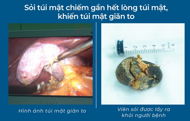 Ph&aacute;t hiện sỏi t&uacute;i mật lớn gần bằng quả trứng g&agrave; khi kh&aacute;m sức khỏe định kỳ - Ảnh 1.