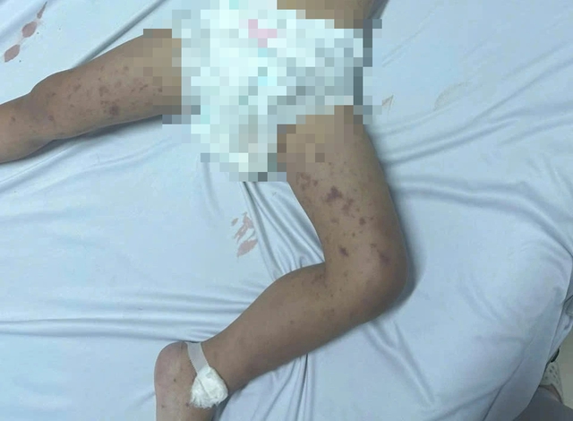 Xuất hiện vi&ecirc;m n&atilde;o m&ocirc; cầu, Đắk Lắk khẩn trương truy vết người tiếp x&uacute;c- Ảnh 1.