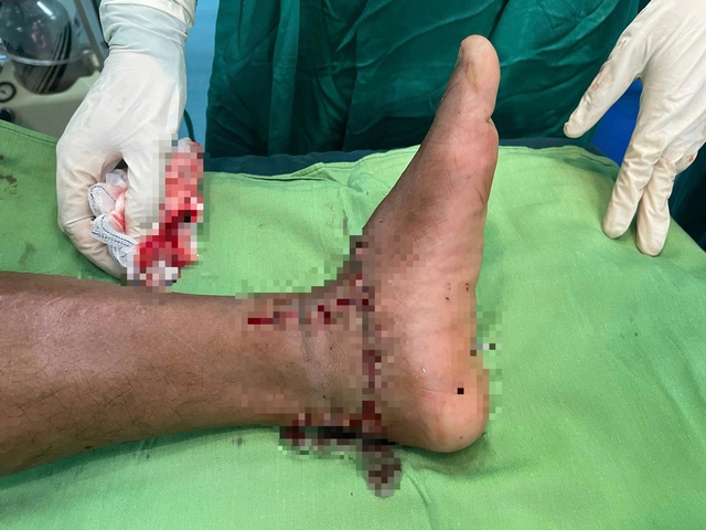 K&iacute;ch hoạt b&aacute;o động đỏ, cứu th&agrave;nh c&ocirc;ng ca đứt l&igrave;a b&agrave;n ch&acirc;n do m&aacute;y cắt cỏ- Ảnh 2.