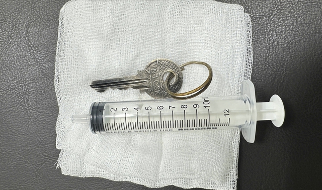  Bé trai 14 tuổi nuốt chìa khóa, bác sĩ nội soi gắp thành công - Ảnh 2.