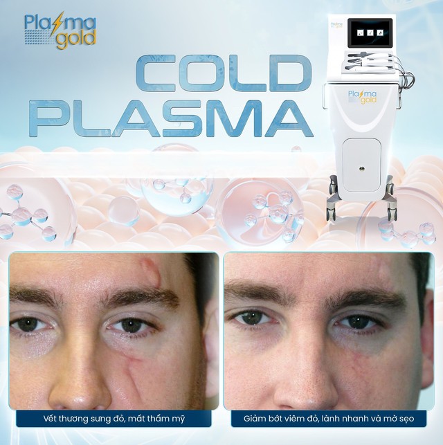 Chuy&ecirc;n gia bất ngờ ứng dụng của Plasma lạnh hiệu quả sau 1 liệu tr&igrave;nh - Ảnh 1.