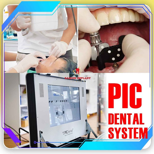 PIC Dental v&agrave; Face Scan 3D - Ti&ecirc;u chuẩn v&agrave;ng cho phục h&igrave;nh Implant to&agrave;n h&agrave;m  - Ảnh 1.