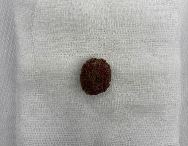 TP.HCM: Tin v&agrave;o 'thuốc tan sỏi thận' tr&ecirc;n mạng, người đ&agrave;n &ocirc;ng nhập viện nguy kịch - Ảnh 1.