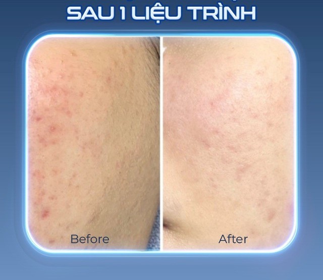 Chuy&ecirc;n gia bất ngờ ứng dụng của Plasma lạnh hiệu quả sau 1 liệu tr&igrave;nh - Ảnh 6.