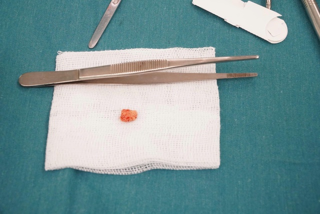 Lần đầu ti&ecirc;n Bệnh viện đa khoa Vũng T&agrave;u phẫu thuật lấy sỏi tuyến dưới h&agrave;m - Ảnh 1.