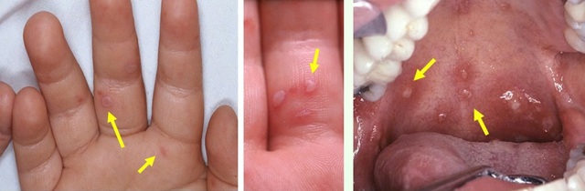 TP.HCM: Biến thể mới g&acirc;y tay ch&acirc;n miệng nguy hiểm thế n&agrave;o v&agrave; dấu hiệu chuyển nặng? - Ảnh 1.