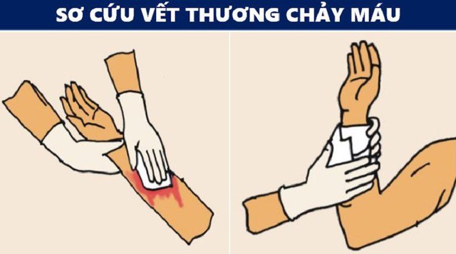 Bật m&iacute; c&aacute;ch xử l&yacute; vết thương chuẩn y khoa m&agrave; nhiều người thực hiện sai- Ảnh 3.