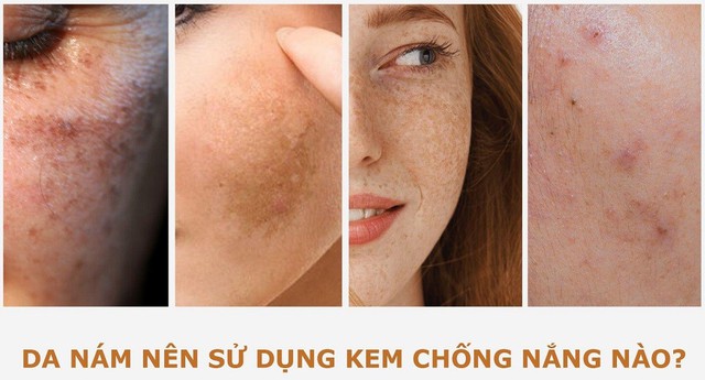 N&aacute;m t&aacute;i đi t&aacute;i lại do chưa &lsquo;update&rsquo; 3 kem chống nắng cho da n&aacute;m dưới đ&acirc;y! - Ảnh 1.