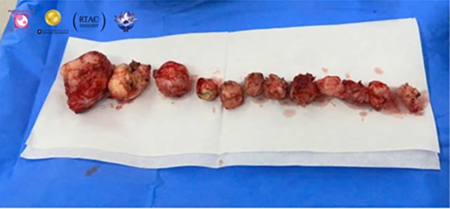 H&agrave;nh tr&igrave;nh b&oacute;c t&aacute;ch 12 khối u xơ tử cung 'ẩn m&igrave;nh' tại Bệnh viện Phương Nam - Ảnh 2.