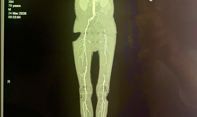 Loét gót chân và bệnh lý động mạch chi dưới: Nguy cơ họai tử Cần lưu ý - Ảnh 1. Loét gót chân kéo dài, bệnh nhân suýt phải cưa chân - Ảnh 1.