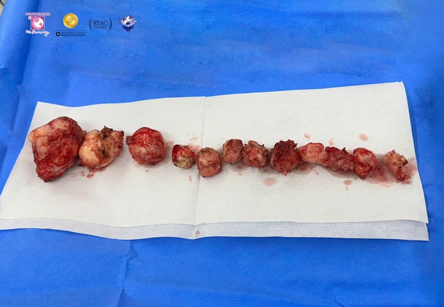 Hành trình bóc tách 12 khối u xơ tử cung 'ẩn mình' tại Bệnh viện Phương Nam - Ảnh 2.