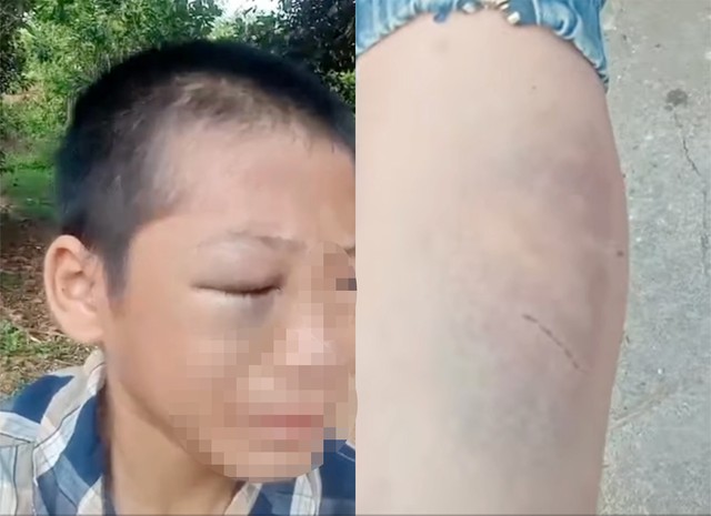 B&eacute; trai cầu cứu v&igrave; bị bạo h&agrave;nh, người th&acirc;n n&oacute;i g&igrave;? - Ảnh 2.