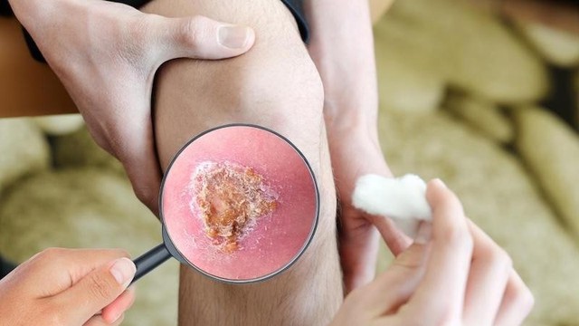 Giải m&atilde; &lsquo;cuộc chiến&rsquo; vi m&ocirc; tại vết thương: Khi sự kiểm so&aacute;t quyết định phục hồi - Ảnh 1.