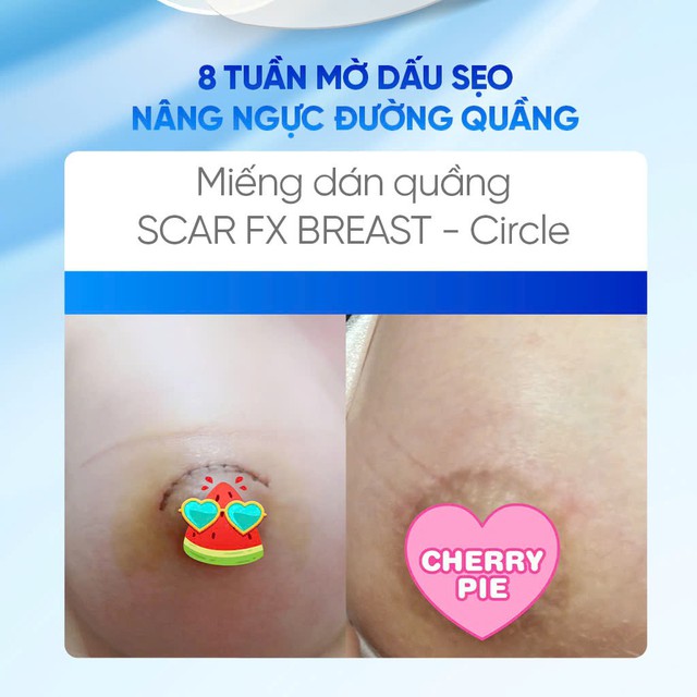 Phẫu thuật treo sa trễ d&ugrave;ng miếng d&aacute;n silicone n&agrave;o để da phẳng như chưa dao k&eacute;o?- Ảnh 7.