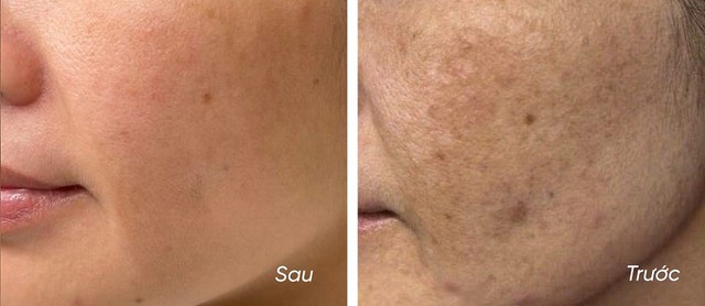 5 kem giúp mờ nám da trắng sáng sau khoảng 4 tuần, kể cả nám hỗn hợp - Ảnh 1.
