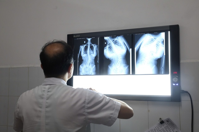 Nhận biết sớm dấu hiệu bệnh cong vẹo cột sống ở trẻ em - Ảnh 1.