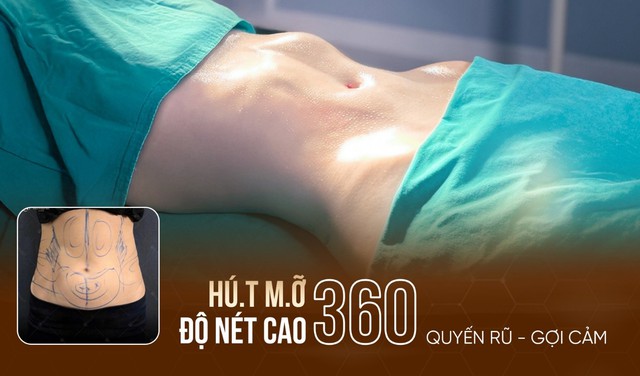 Từ áp lực ngoại hình đến sống khỏe: Hút mỡ độ nét cao được quan tâm - Ảnh 1.