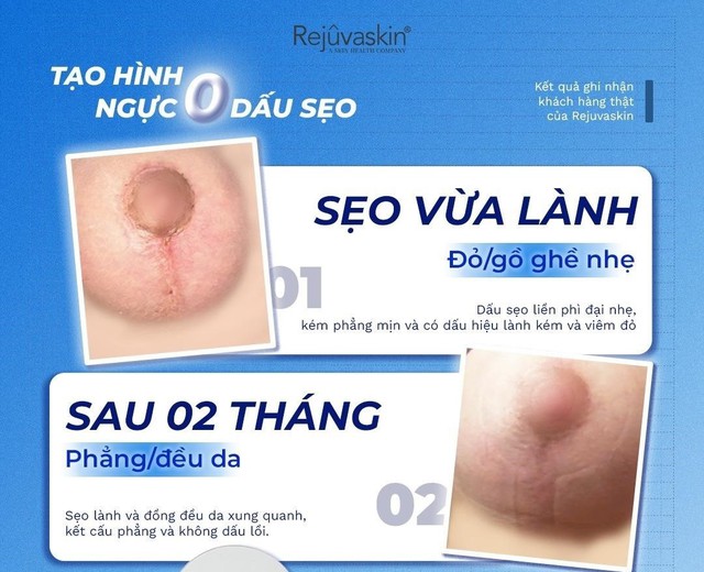 Sẹo mới: Cách xử lý hiệu quả với Scar FX và Rejuvasil Silicone Gel - Ảnh 5.