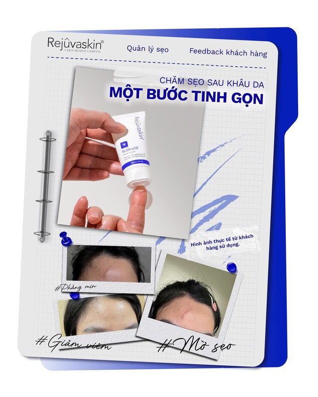 Gel Rejuvasil giúp ngăn ngừa sẹo mới và làm mờ sẹo lồi phẫu thuật có tốt không? - Ảnh 3.
