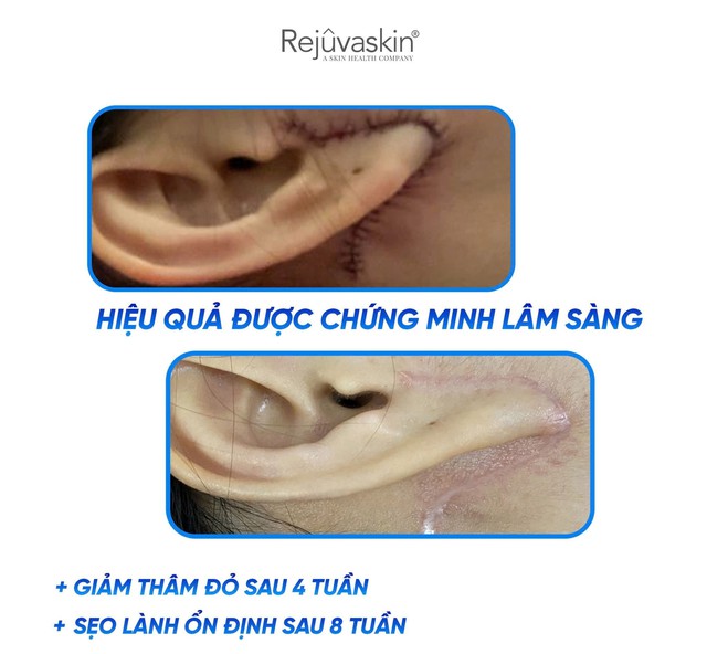 Gel Rejuvasil giúp ngăn ngừa sẹo mới và làm mờ sẹo lồi phẫu thuật có tốt không? - Ảnh 8.