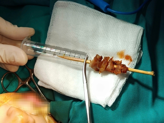 B&eacute; g&aacute;i 2,5 tuổi bị que xi&ecirc;n thịt đ&acirc;m s&acirc;u đến hốc mắt  - Ảnh 1.