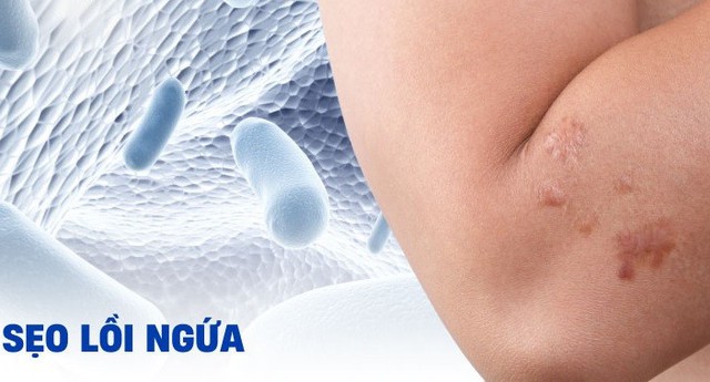 Chuy&ecirc;n gia gợi &yacute; c&aacute;ch d&ugrave;ng kem mờ sẹo lồi hiệu quả sau khoảng 4 tuần- Ảnh 2.
