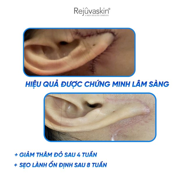 Chuy&ecirc;n gia gợi &yacute; c&aacute;ch d&ugrave;ng kem mờ sẹo lồi hiệu quả sau khoảng 4 tuần- Ảnh 9.