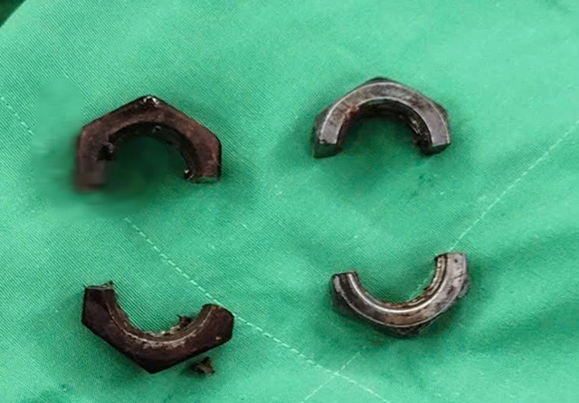 Su&yacute;t phải cắt bỏ dương vật bị 2 con ốc kim loại siết chặt - Ảnh 2.