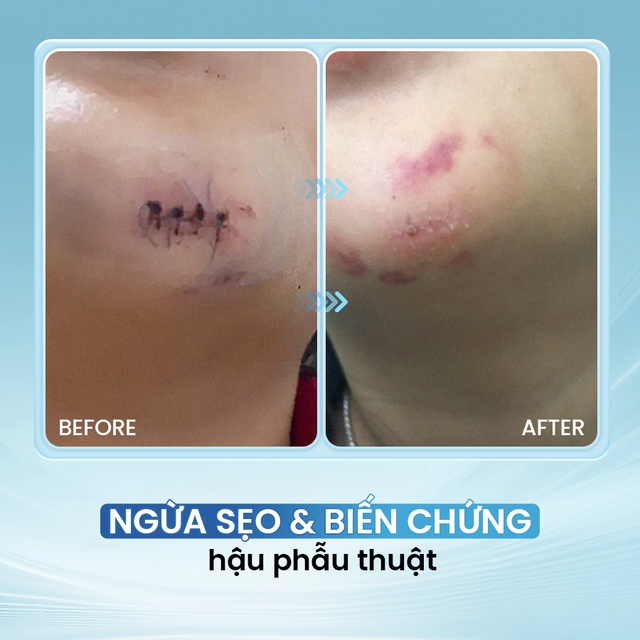C&aacute;ch d&ugrave;ng kem b&ocirc;i vết thương hở tưởng đơn giản nhưng nhiều người vẫn l&agrave;m sai - Ảnh 12.