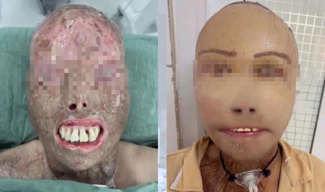 Người đ&agrave;n &ocirc;ng ng&atilde; v&agrave;o nồi nước s&ocirc;i v&agrave; h&agrave;nh tr&igrave;nh 16 giờ 'trao trả' gương mặt - Ảnh 1.