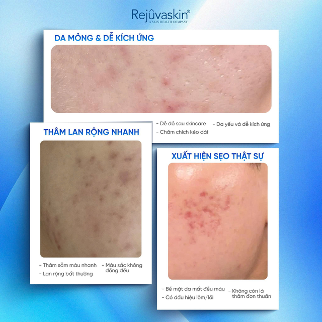Phục hồi da sau laser: Điều đáng sợ không phải bong da mà là chăm sai cách- Ảnh 2. Phục hồi da sau laser: Điều đáng sợ không phải bong da mà là chăm sai cách- Ảnh 2.