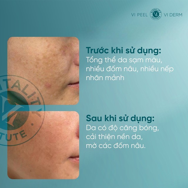 Top 5 retinol cho da l&atilde;o h&oacute;a U.30+ &lsquo;trẻ h&oacute;a&rsquo; tưởng như U.20 sau khoảng 4 tuần- Ảnh 4.