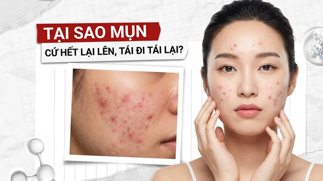 Mụn tái đi tái lại, mãi không hết vì chưa biết đến serum cho da mụn này! - Ảnh 2.