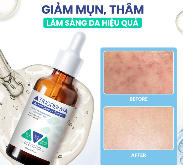 Mụn tái đi tái lại, mãi không hết vì chưa biết đến serum cho da mụn này! - Ảnh 6.