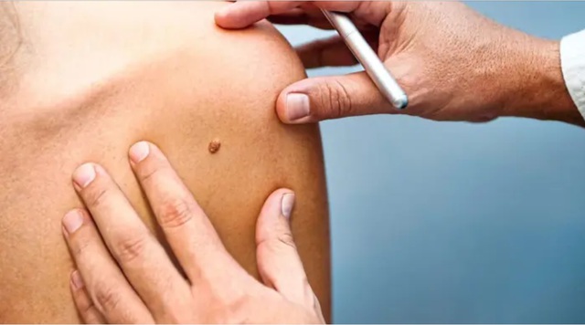 Giới khoa học công bố kết quả nghiên cứu mới về nốt ruồi - Ảnh 1.