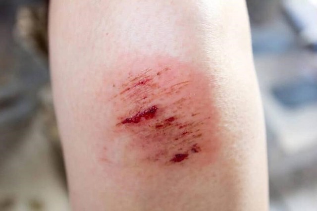 Bị thương ngo&agrave;i da: Sai lầm nhỏ c&oacute; thể khiến vết thương l&acirc;u l&agrave;nh - Ảnh 1.