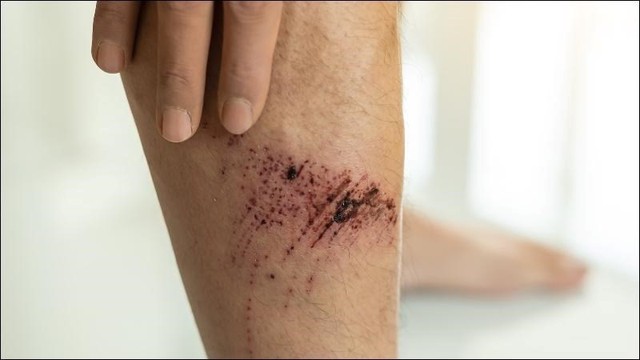 Bị thương ngo&agrave;i da: Sai lầm nhỏ c&oacute; thể khiến vết thương l&acirc;u l&agrave;nh - Ảnh 3.