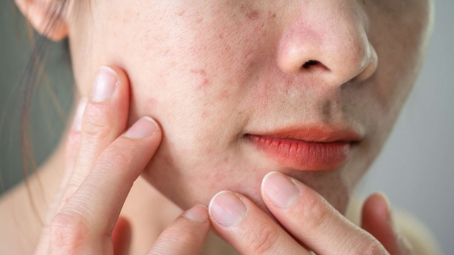 Vì sao cùng một chu trình nhưng da vẫn breakout khi hè đến? Giải đáp với Trioderma - Ảnh 2.