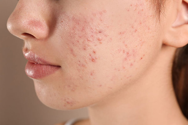 Vì sao cùng một chu trình nhưng da vẫn breakout khi hè đến? Giải đáp với Trioderma - Ảnh 3.