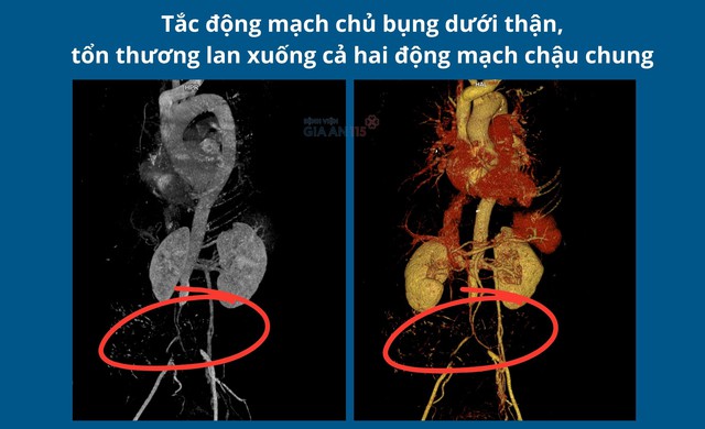 Tưởng thoái hóa khớp, người phụ nữ phát hiện động mạch chủ bụng bị tắc hoàn toàn - Ảnh 1.