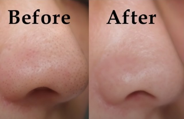 Kem gi&uacute;p ngừa mụn đầu đen cực đỉnh: Mũi sạch bong, căng b&oacute;ng như vừa đi spa - Ảnh 12.