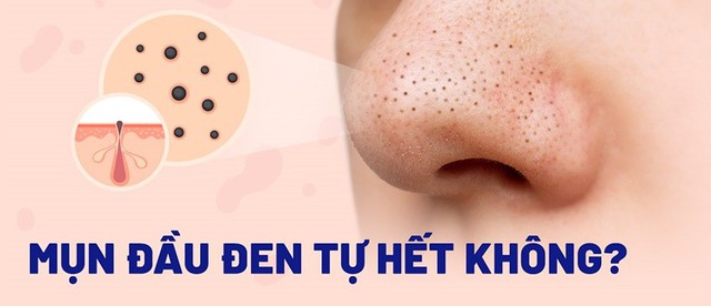 Kem gi&uacute;p ngừa mụn đầu đen cực đỉnh: Mũi sạch bong, căng b&oacute;ng như vừa đi spa - Ảnh 2.